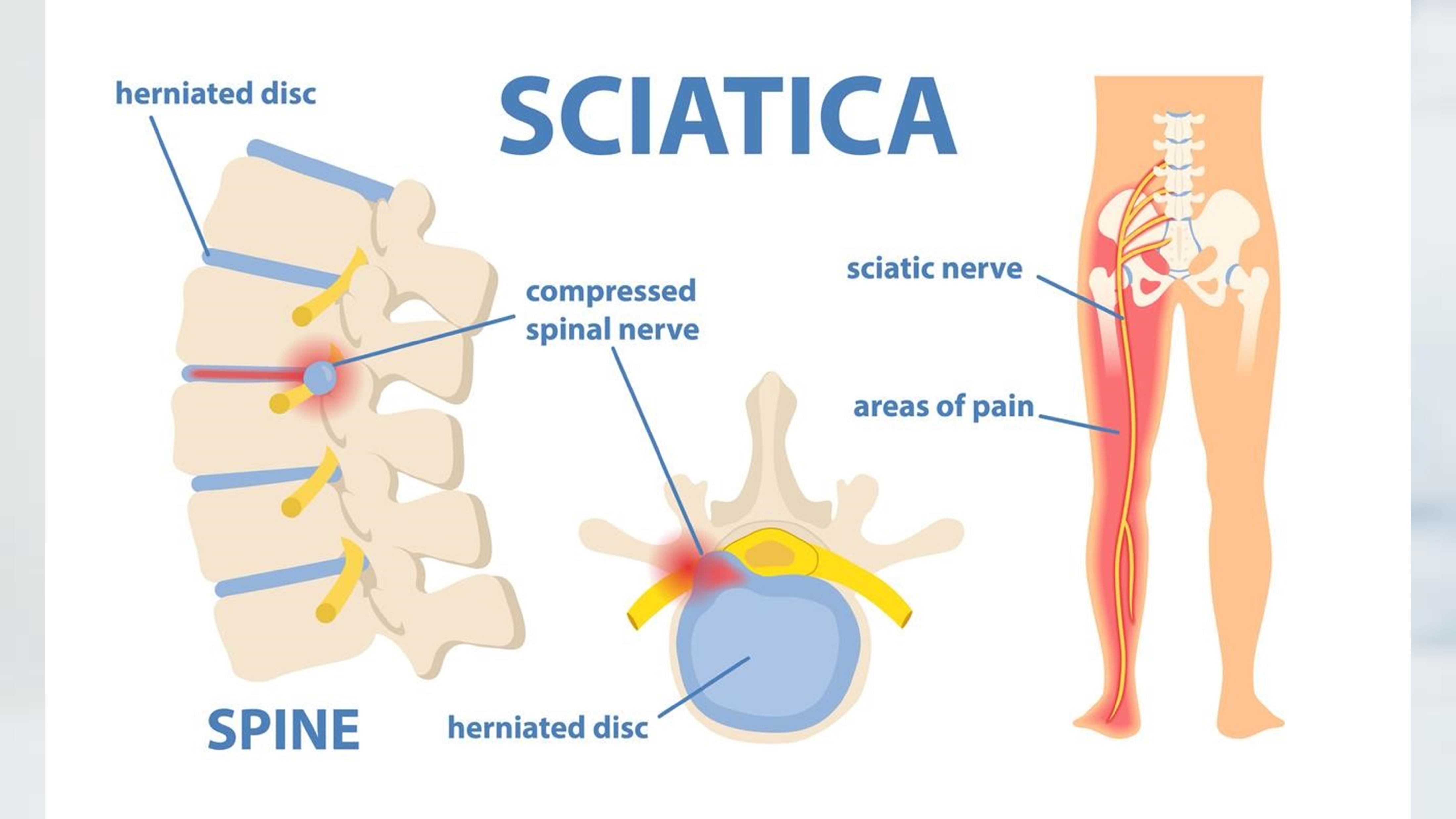 sciatica