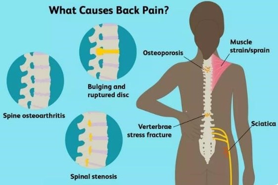 whatcausesbackpain